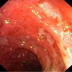 Colon mucosal of this patient before treatment