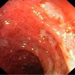 Слизова товстої кишки даного пацієнта до лікування