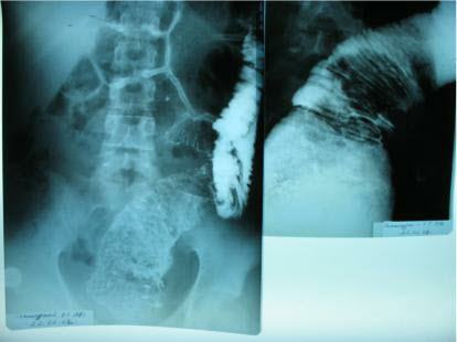 Colon mucosal of this patient before treatment