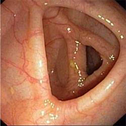 Colon mucosal of this patient after treatment