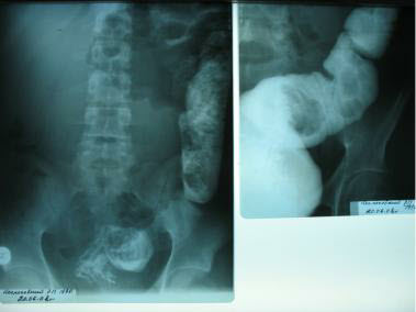 Colon mucosal of this patient after treatment
