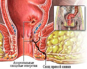 Anorectal abscess