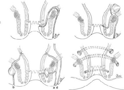 Internal openings Anal fistula