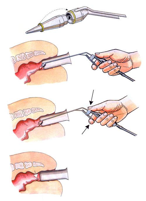 Rubber band ligation of hemorrhoidal piles