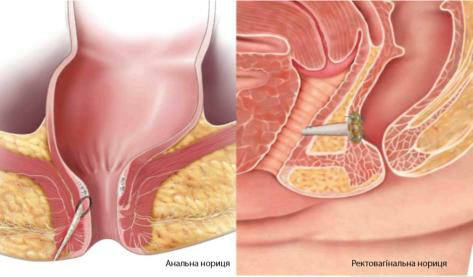 Treatment of anal fistula with plug - Cook® Surgisis® Biodesign ТМ Anal Fistula Plug