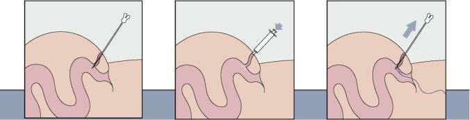 Treatment of anal fistula with plug - Cook® Surgisis® Biodesign ТМ Anal Fistula Plug