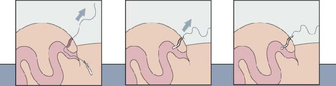 Treatment of anal fistula with plug - Cook® Surgisis® Biodesign ТМ Anal Fistula Plug